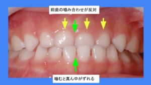 乳歯のはならび 望ましくない状態 - はえかわり中の治療なら池田